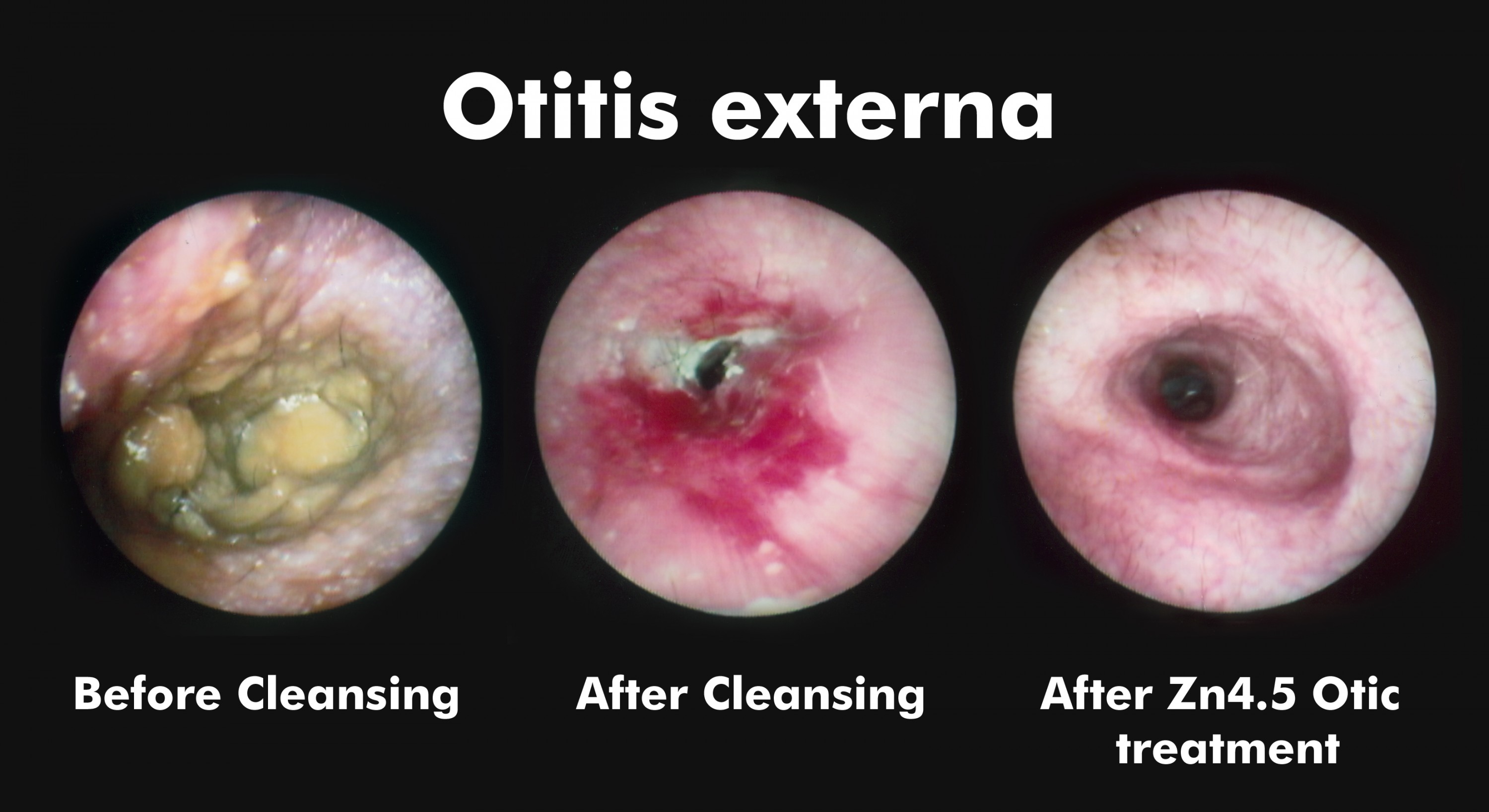 Otitisexternaprogression