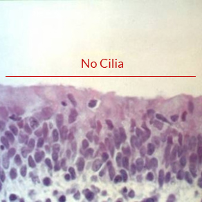 Epithelial damage typical of B. bronchiseptica infection. Without the functional ciliated epithelium, the mucous layer is static. Trapped organisms are not eliminated and instead are allowed to reproduce and dramatically increase the challenge to the pig’s system. At some point, the challenge may overwhelm the immune defenses and result in respiratory disease and/or intoxication as with P. multocida.